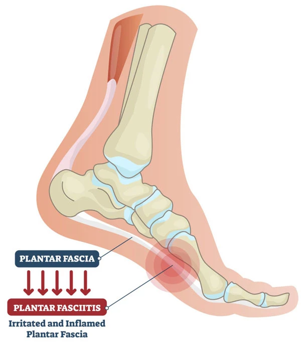 Plantar Fasciitis